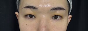 眉下切開の2日目経過