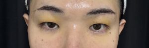 眉下切開の3日目経過