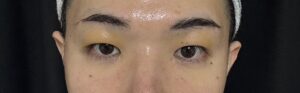 眉下切開の4日目経過