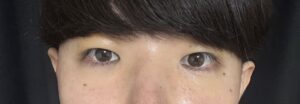 眉下切開の5日目経過
