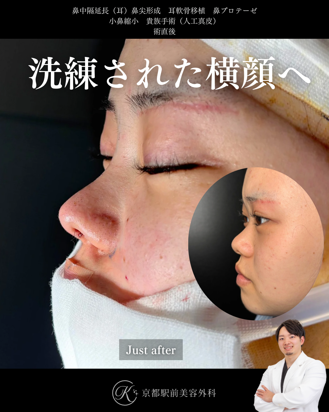 鼻整形（鼻尖形成オープン法・耳軟骨移植・鼻中隔延長術・鼻プロテーゼ・小鼻縮小）と貴族手術（人工真皮）の術直後写真（京都駅前美容外科の症例）