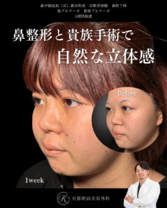 鼻整形(鼻尖形成オープン法・耳軟骨移植・鼻中隔延長術・プロテーゼ)と貴族手術(基部プロテーゼ)の1週間後経過写真(京都駅前美容外科の症例)