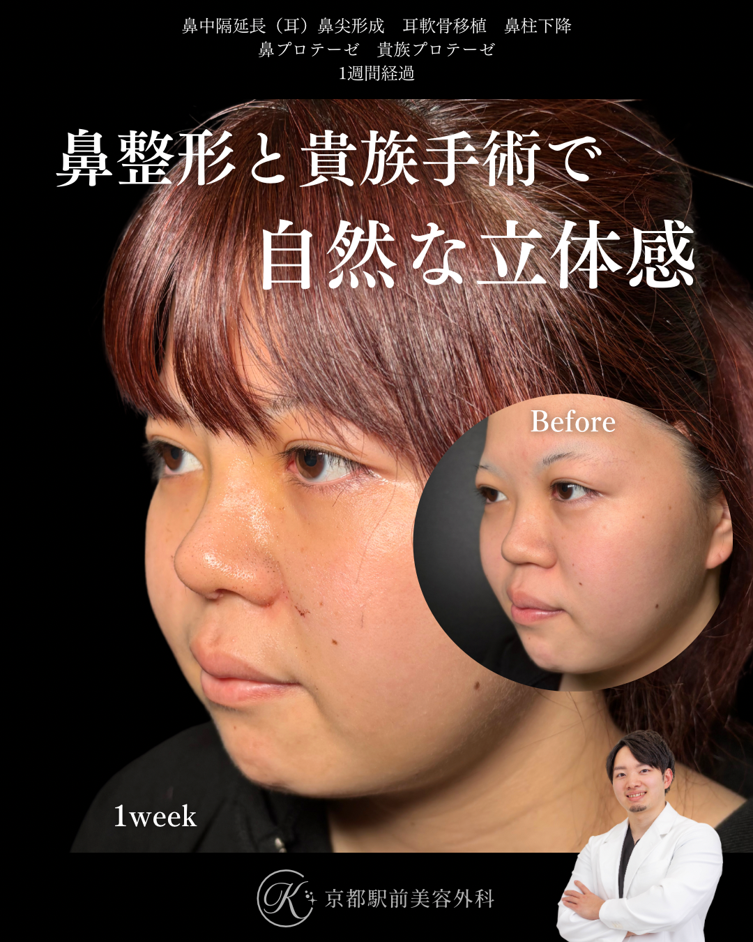 鼻整形（鼻尖形成オープン法・耳軟骨移植・鼻中隔延長術・プロテーゼ）と貴族手術（基部プロテーゼ）の１週間後経過写真（京都駅前美容外科の症例）