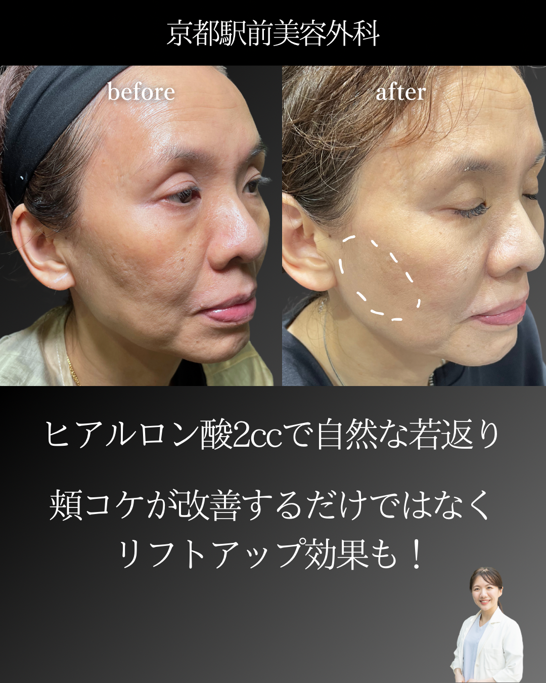 頬のヒアルロン酸（京都駅前美容外科の症例）