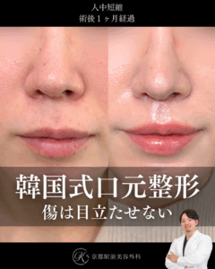 人中短縮の術後経過写真(京都駅前美容外科の症例)