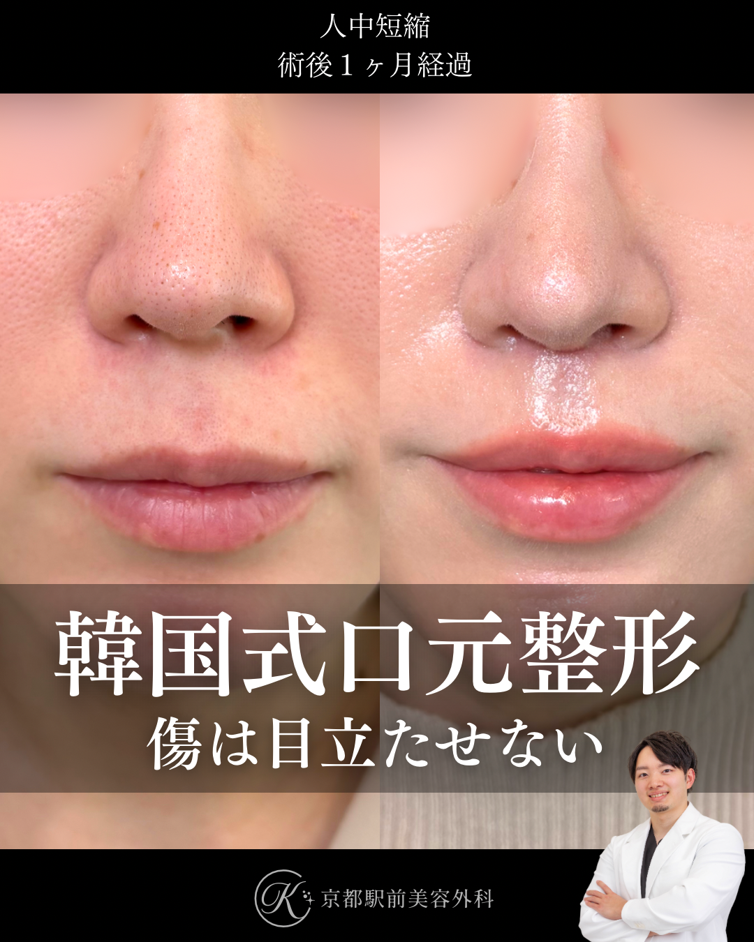 人中短縮の術後経過写真（京都駅前美容外科の症例）