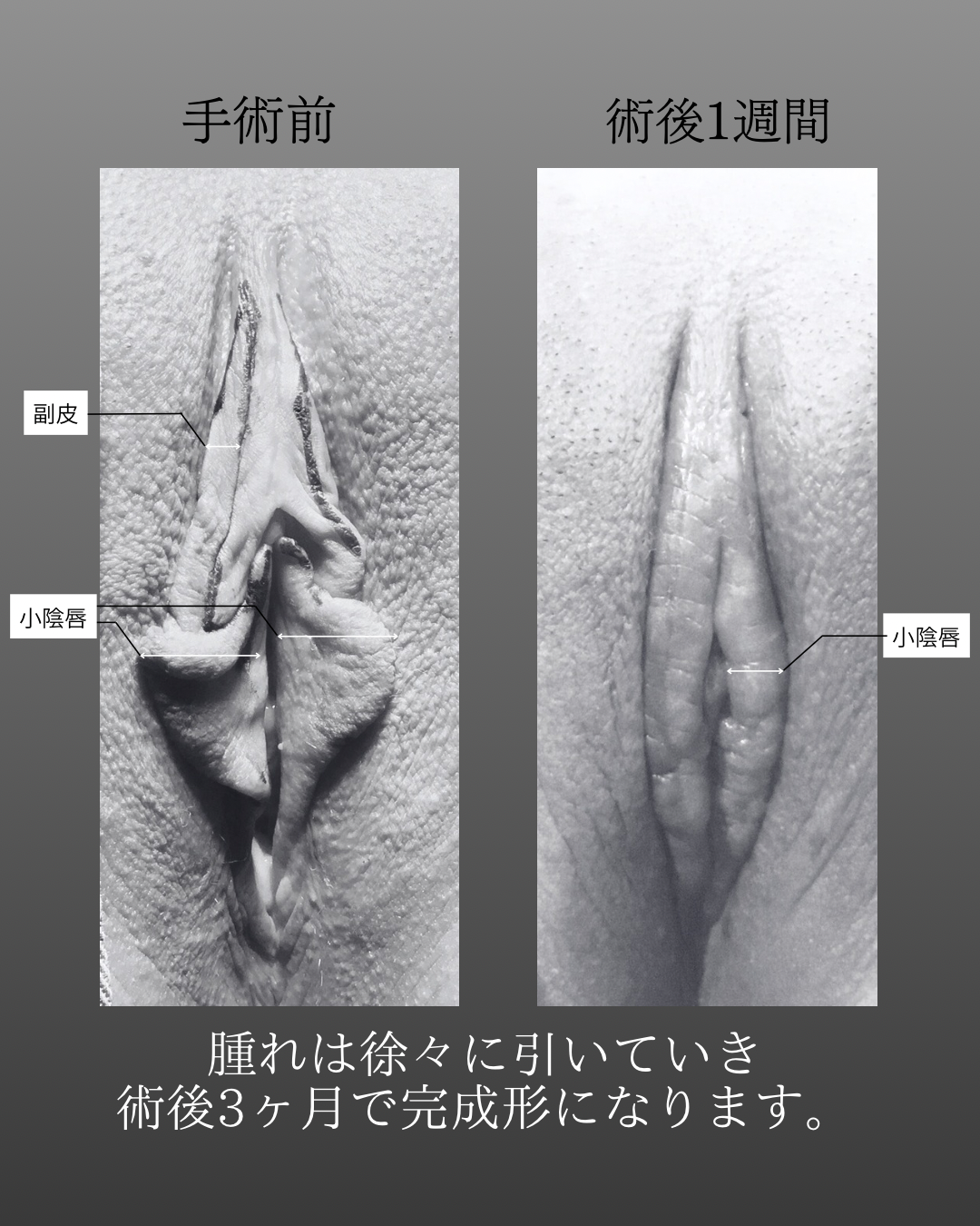 小陰唇縮小術・副皮除去の術後1週間の症例写真