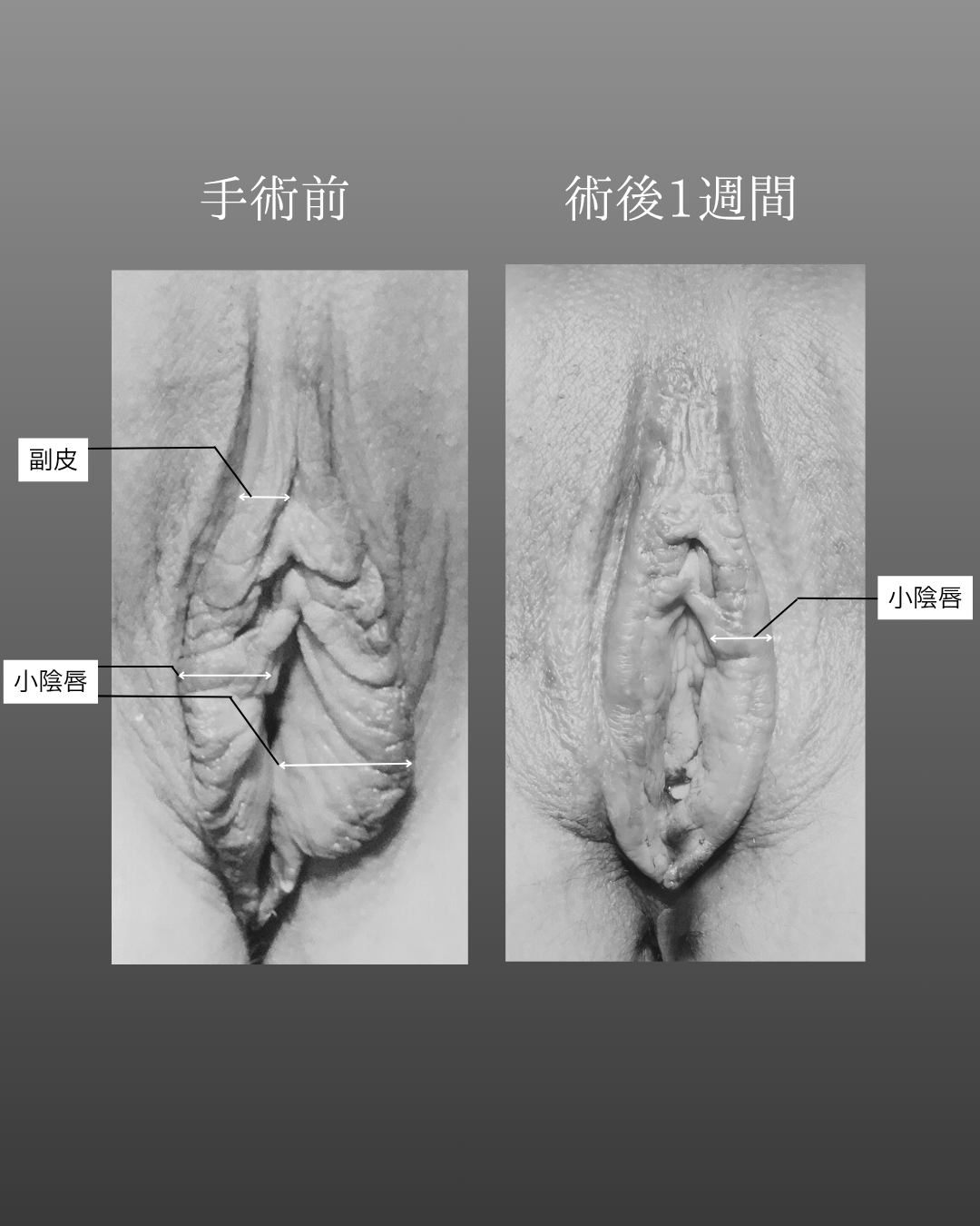 小陰唇縮小術・副皮除去術