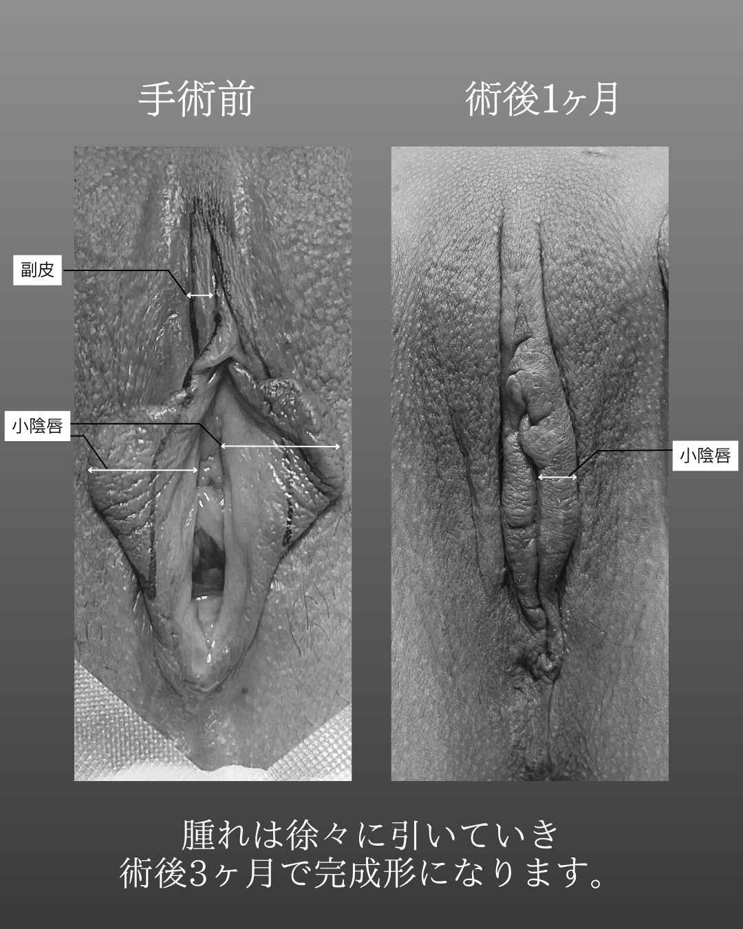 小陰唇縮小術・副皮除去の術後1ヶ月後経過の症例写真