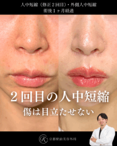 人中短縮の修正と外側人中短縮術の症例写真