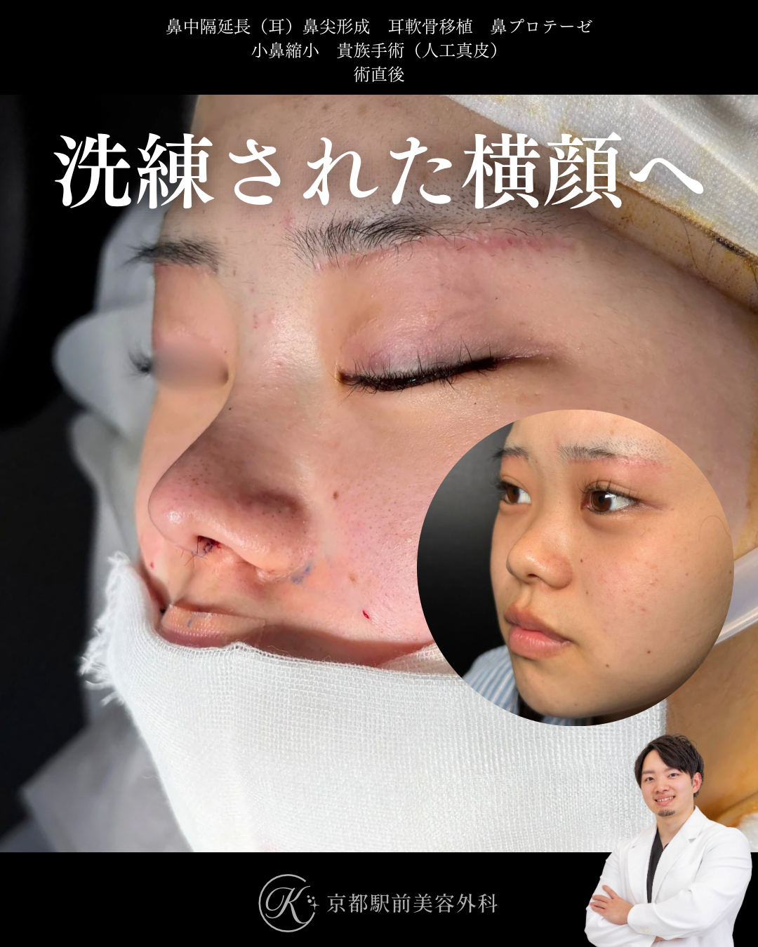 鼻整形（鼻尖形成オープン法・耳軟骨移植・鼻中隔延長術・鼻プロテーゼ・小鼻縮小）と貴族手術（人工真皮）の術直後写真（京都駅前美容外科の症例）