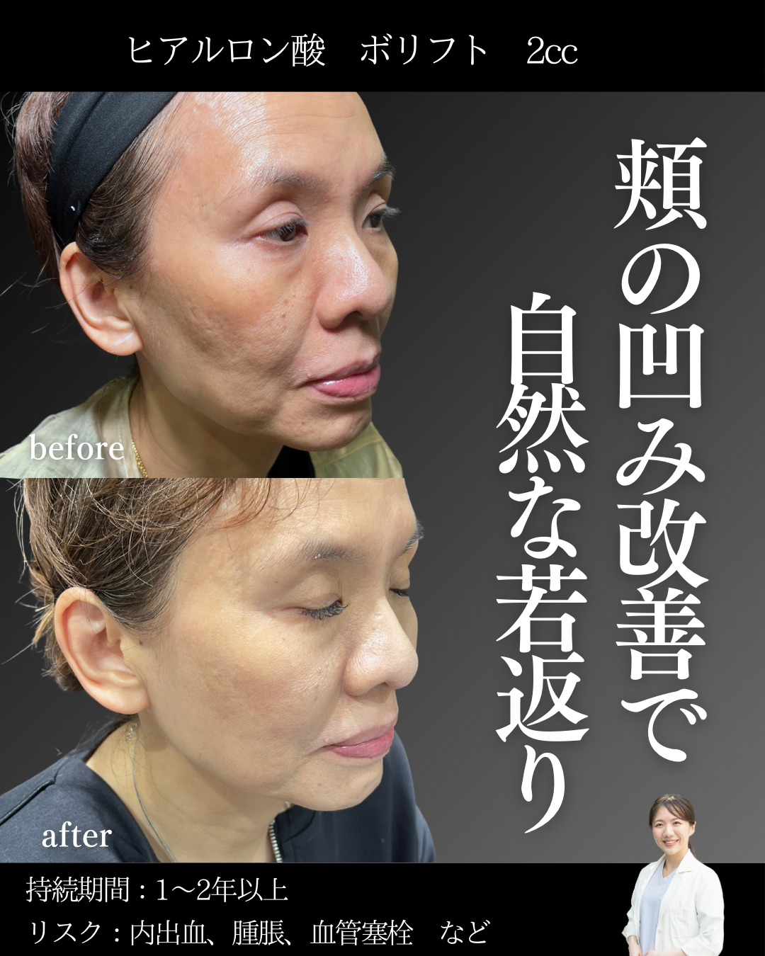 頬のヒアルロン酸（京都駅前美容外科の症例）