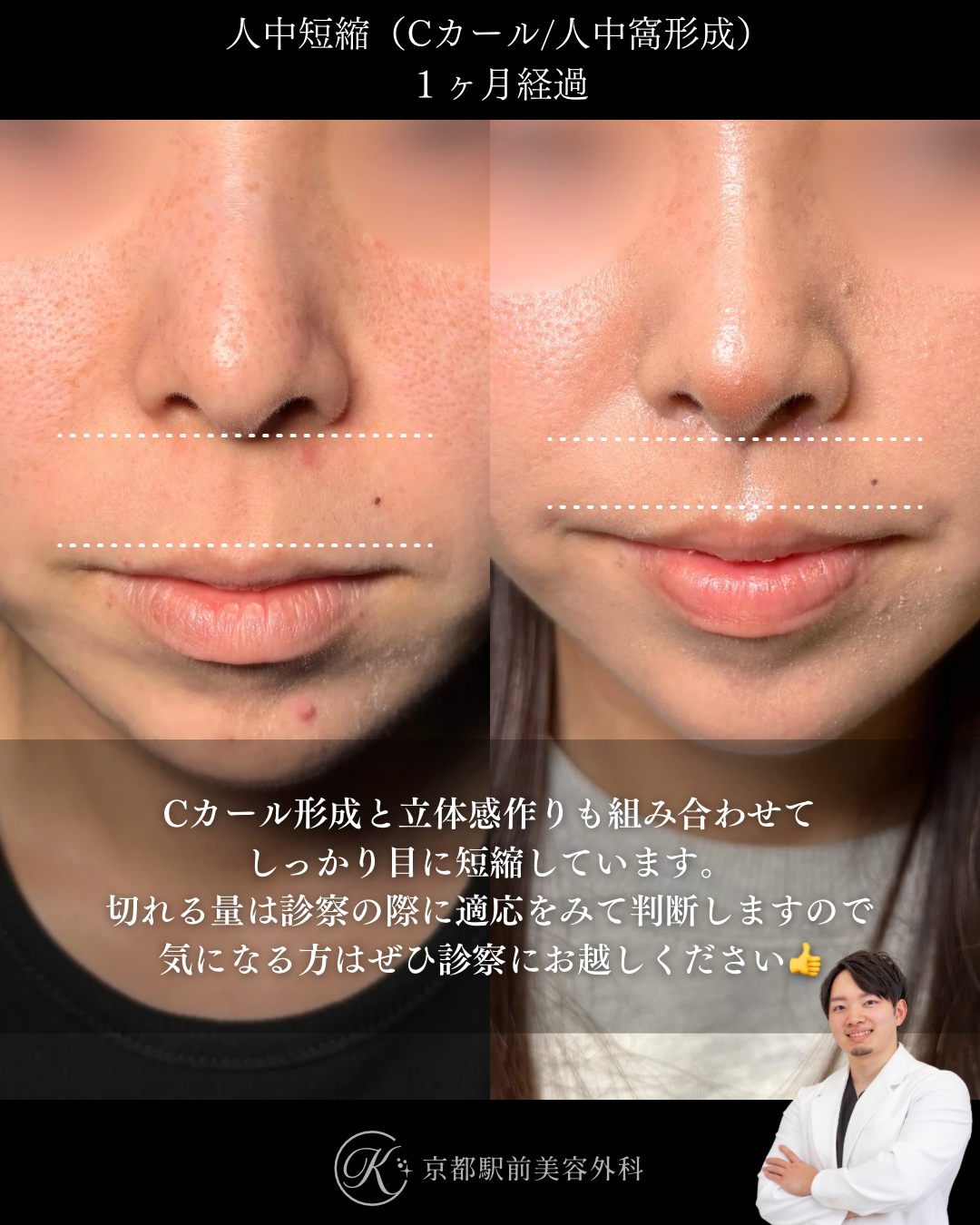 人中短縮１ヶ月後経過写真（京都駅前美容外科の症例）