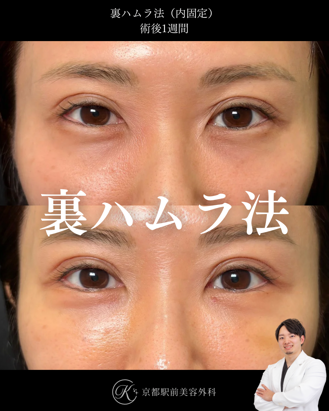 裏ハムラ法（クマ取り）の１週間経過写真（京都駅前美容外科の症例）