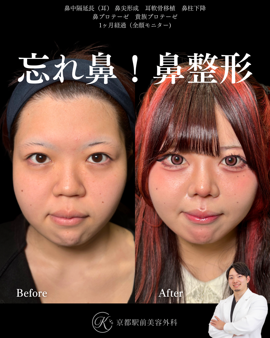 鼻整形（鼻尖形成オープン法・耳軟骨移植・鼻中隔延長術・プロテーゼ）と貴族手術（基部プロテーゼ）の１ヶ月経過写真（京都駅前美容外科の症例）