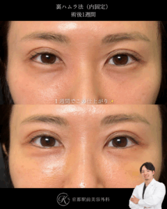 裏ハムラ法（クマ取り）の１週間経過写真（京都駅前美容外科の症例）