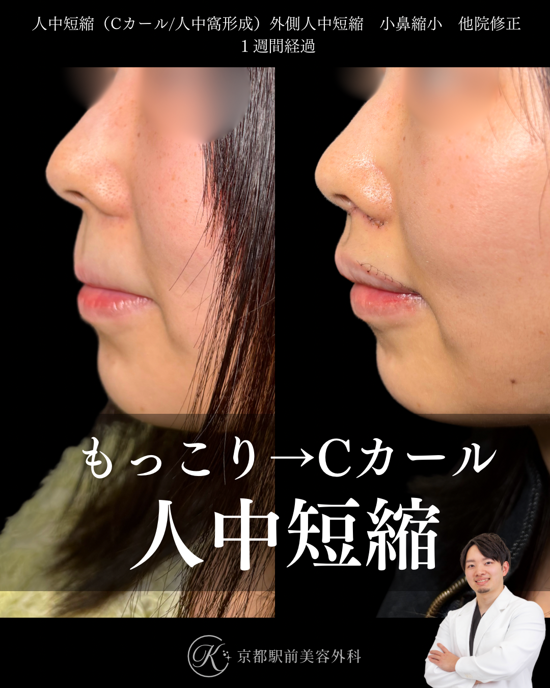 人中短縮と外側人中短縮と小鼻縮小の術後１週間経過時の写真です。