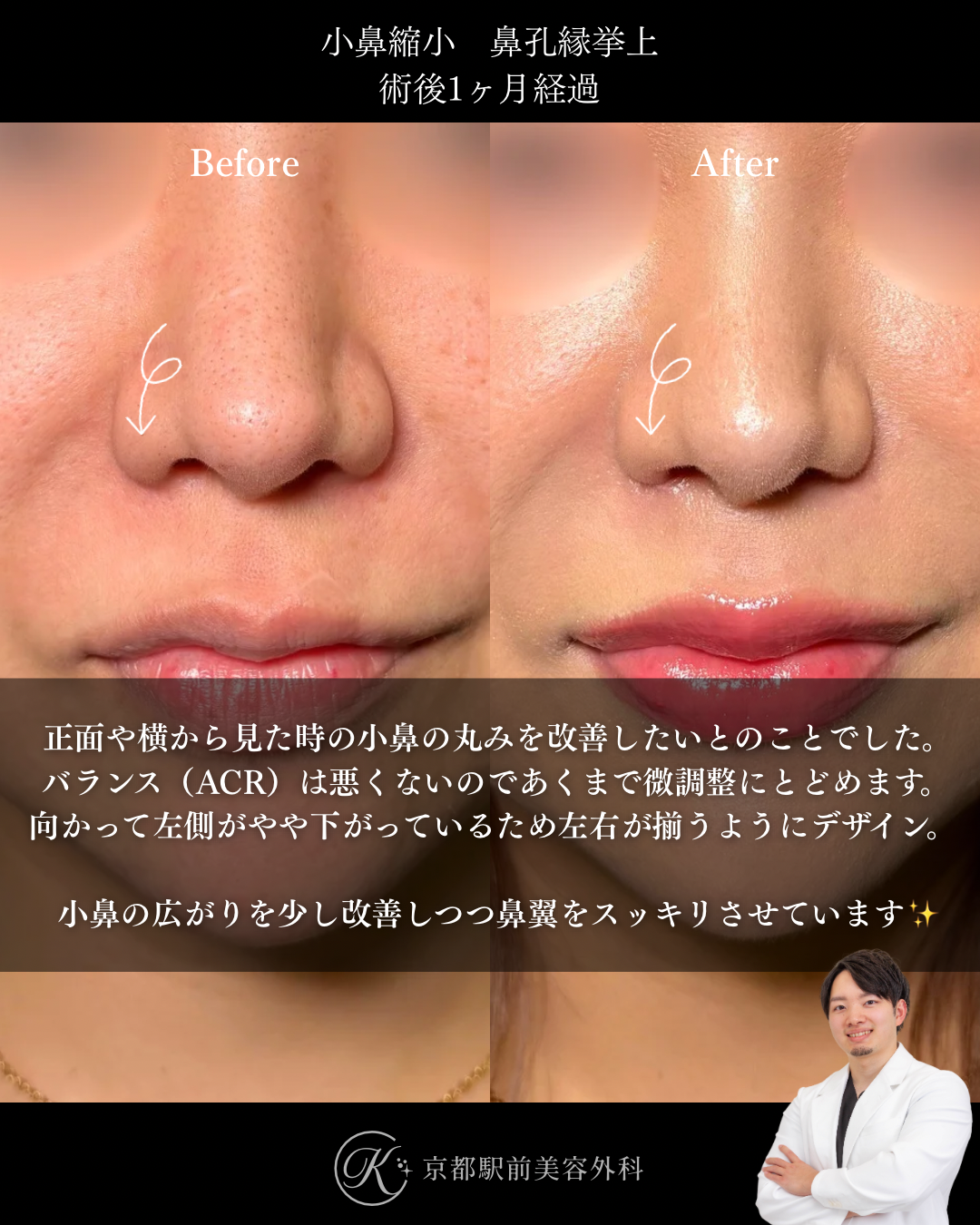 鼻孔縁挙上術と小鼻縮小の1ヶ月経過写真（京都駅前美容外科の症例）