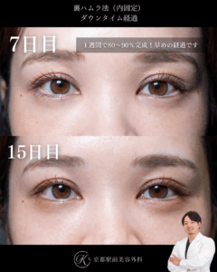 裏ハムラ法のダウンタイム経過、術後7日目と15日目(京都駅前美容外科のコラム)
