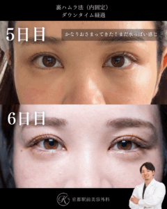 裏ハムラ法のダウンタイム経過、術後5日目と6日目(京都駅前美容外科のコラム)