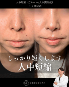 人中短縮１ヶ月後経過写真（京都駅前美容外科の症例）