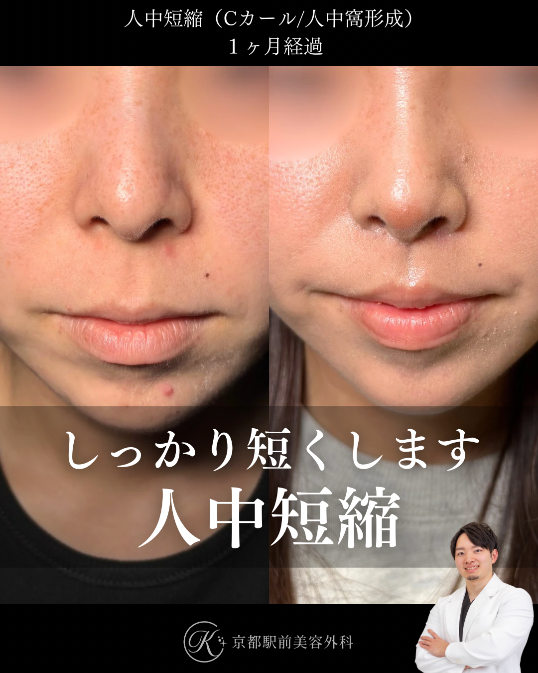 人中短縮１ヶ月後経過写真（京都駅前美容外科の症例）