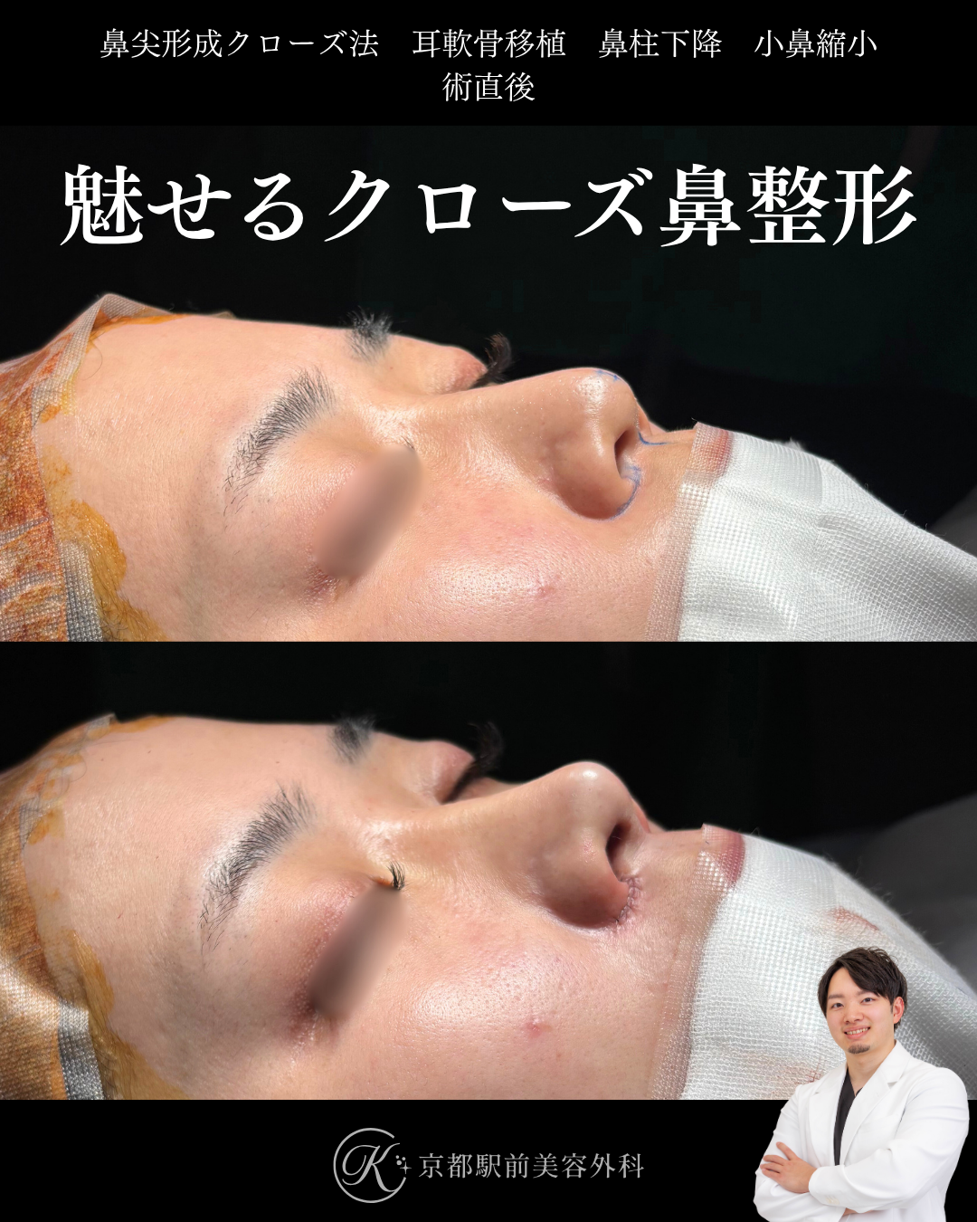 鼻尖形成クローズ法と耳軟骨移植、鼻柱下降、小鼻縮小の術直後写真（京都駅前美容外科の鼻整形症例）