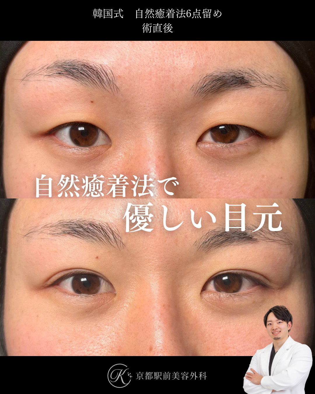 二重埋没法（自然癒着法法6点留め）の術直後写真（京都駅前美容外科の症例）