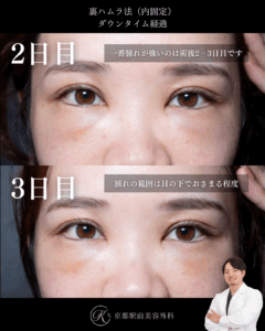 裏ハムラ法のダウンタイム経過、術後2日目と3日目(京都駅前美容外科のコラム)