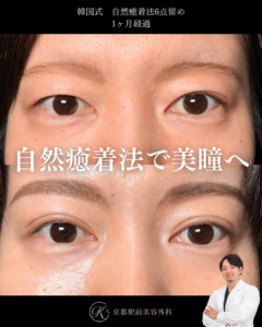 二重埋没法(自然癒着法法6点留め)の1ヶ月経過写真(京都駅前美容外科の症例)