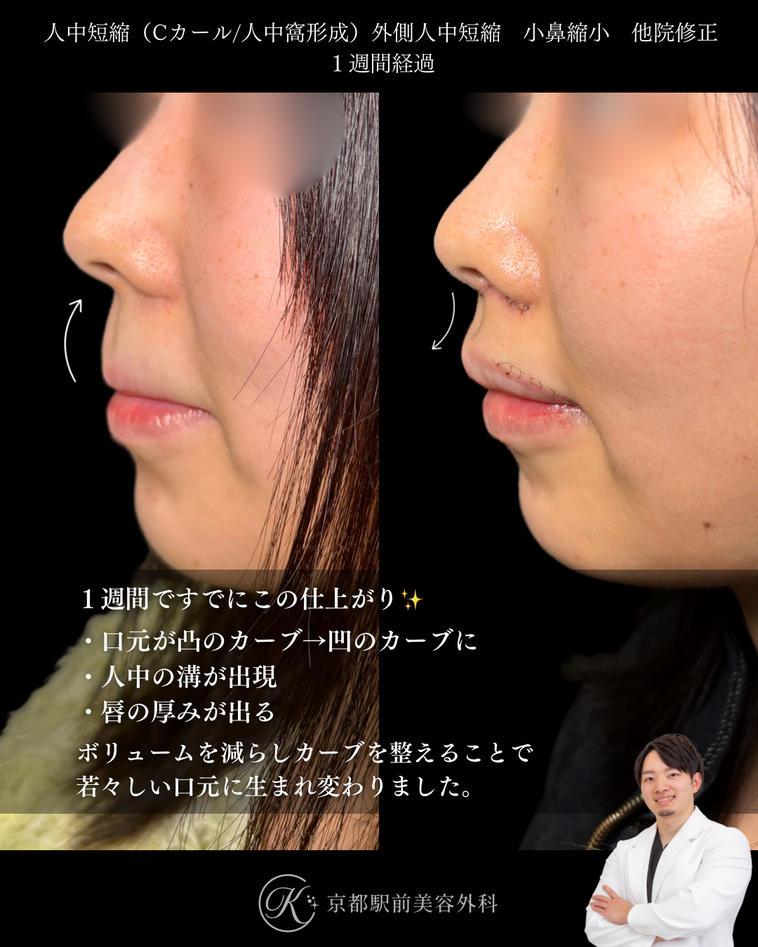 人中短縮と外側人中短縮と小鼻縮小の術後１週間経過時の写真です。