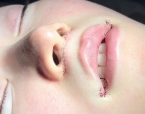 人中短縮の術直後画像(京都駅前美容外科のコラム)、土手下切開