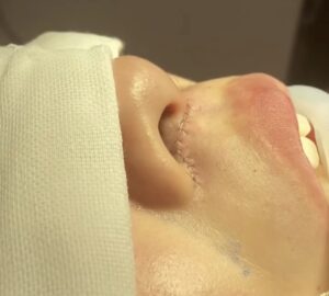 人中短縮の術直後画像(京都駅前美容外科のコラム)