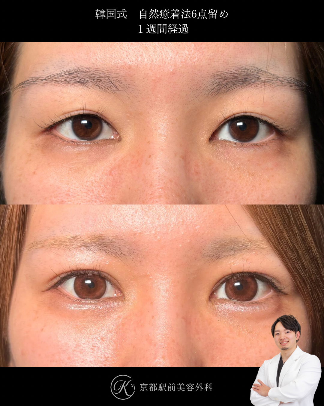 二重埋没法（自然癒着法法6点留め）の１週間後経過写真（京都駅前美容外科の症例）