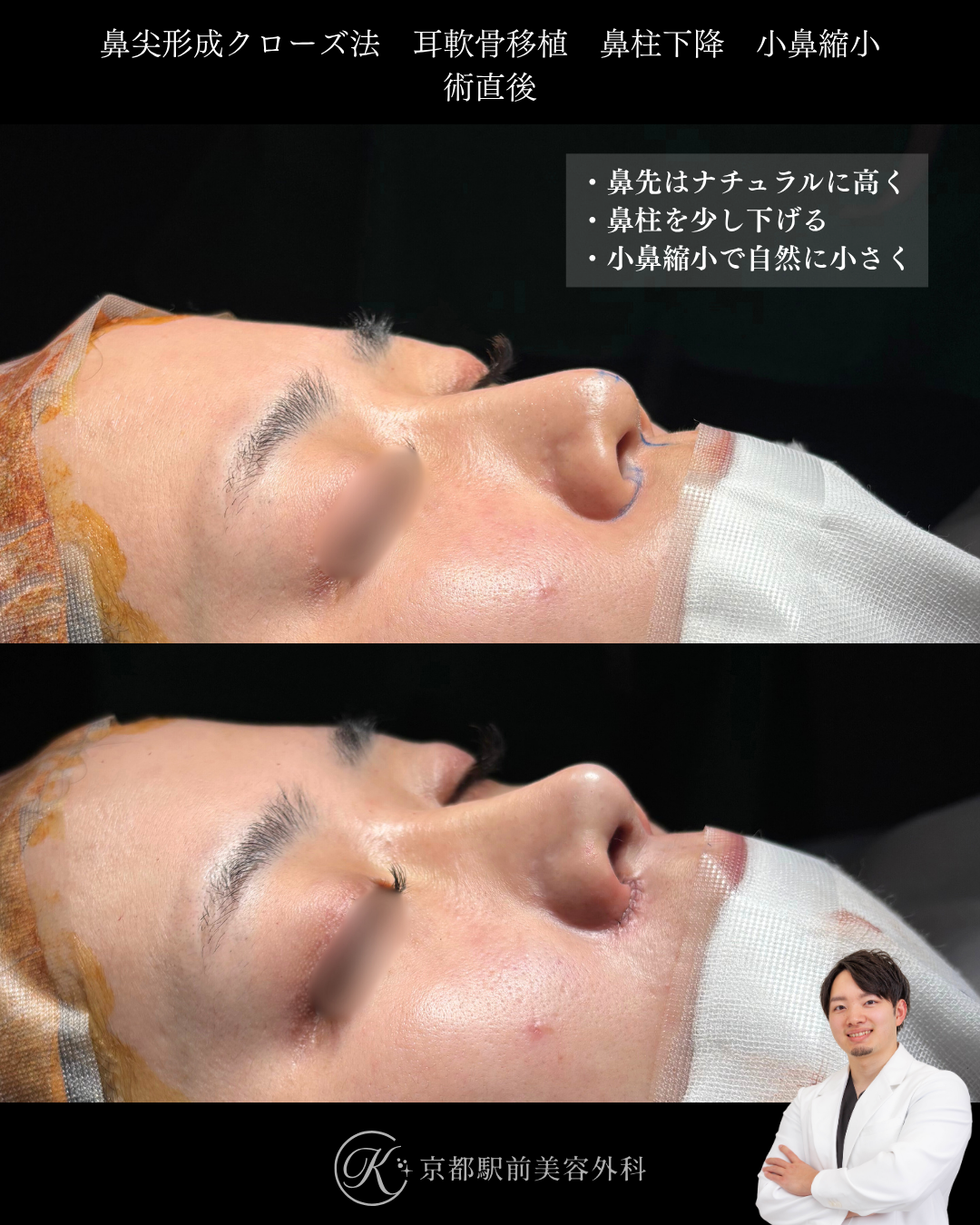 鼻尖形成クローズ法と耳軟骨移植、鼻柱下降、小鼻縮小の術直後写真（京都駅前美容外科の鼻整形症例）