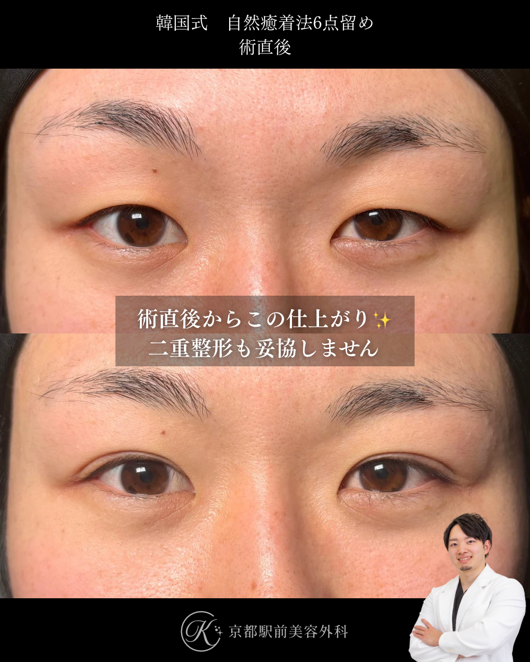二重埋没法（自然癒着法法6点留め）の術直後写真（京都駅前美容外科の症例）