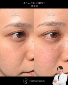 裏ハムラの術直後画像(京都駅前美容外科の症例)