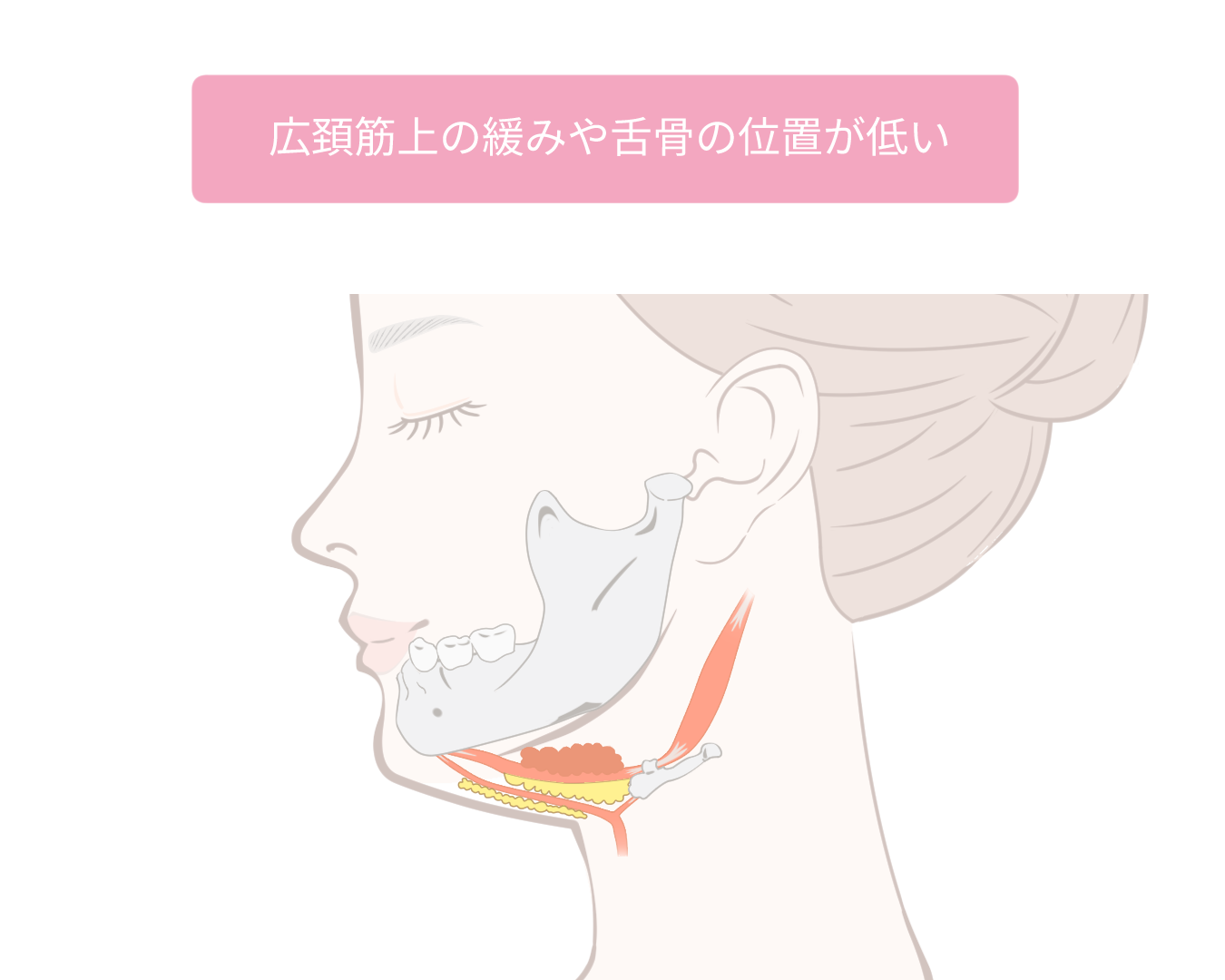 広頚筋上の緩みや舌骨の位置が低い