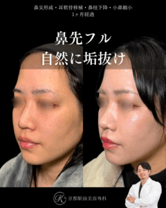 鼻先フル整形で自然に垢抜け。鼻尖形成・耳軟骨移植・鼻柱下降・小鼻縮小の１ヶ月経過写真（京都駅前美容外科の鼻整形症例）