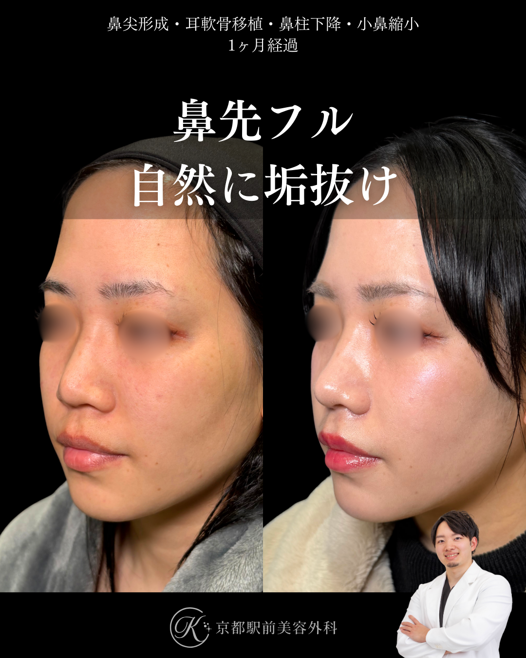 鼻先フル整形で自然に垢抜け。鼻尖形成・耳軟骨移植・鼻柱下降・小鼻縮小の１ヶ月経過写真（京都駅前美容外科の鼻整形症例）