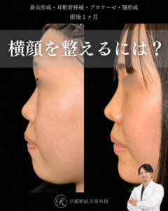 鼻尖形成・耳軟骨移植・プロテーゼ・顎プロテーゼの１ヶ月後写真（京都駅前美容外科の鼻整形症例）