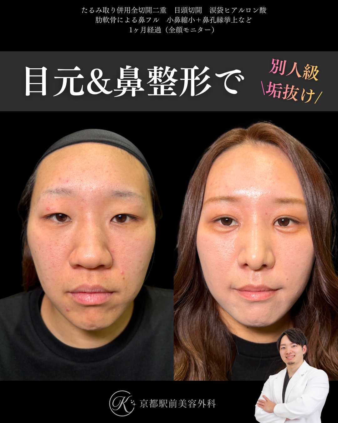 肋軟骨による鼻整形と目元整形(たるみ取り併用全切開と目頭切開と涙袋ヒアルロン酸)の術直後写真(京都駅前美容外科の鼻整形症例)