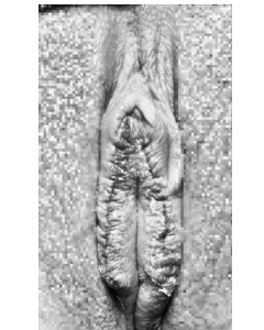 小陰唇縮小術 抜糸なし 手術直後