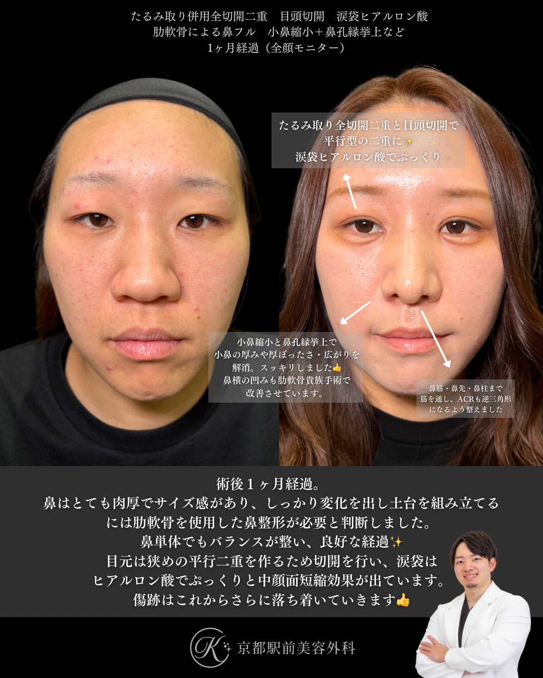 肋軟骨による鼻整形と目元整形（たるみ取り併用全切開と目頭切開と涙袋ヒアルロン酸）の術直後写真（京都駅前美容外科の鼻整形症例）