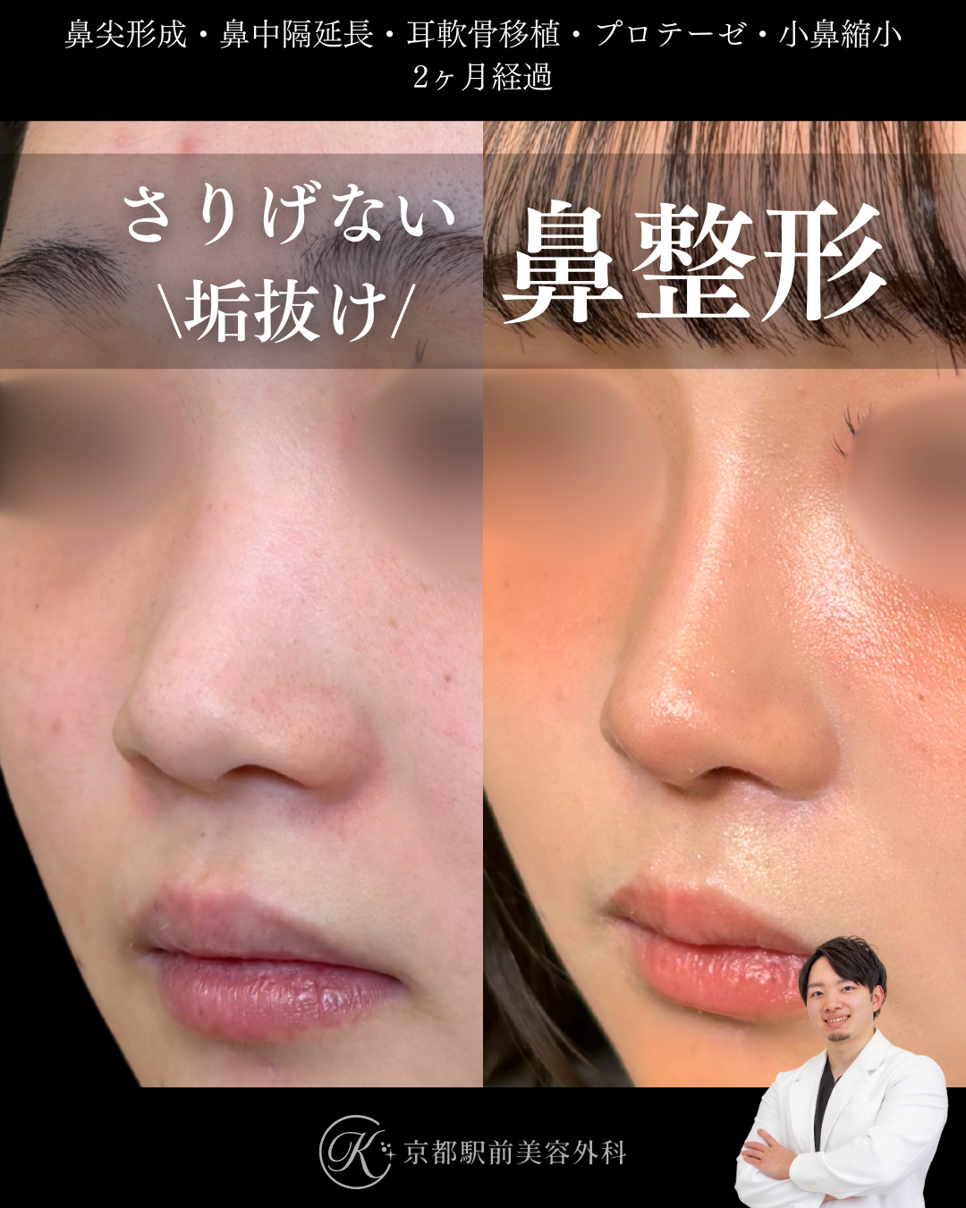 鼻整形（鼻尖形成オープン法・耳軟骨移植・小鼻縮小・鼻中隔延長術・プロテーゼ）の術直後写真（京都駅前美容外科の症例）