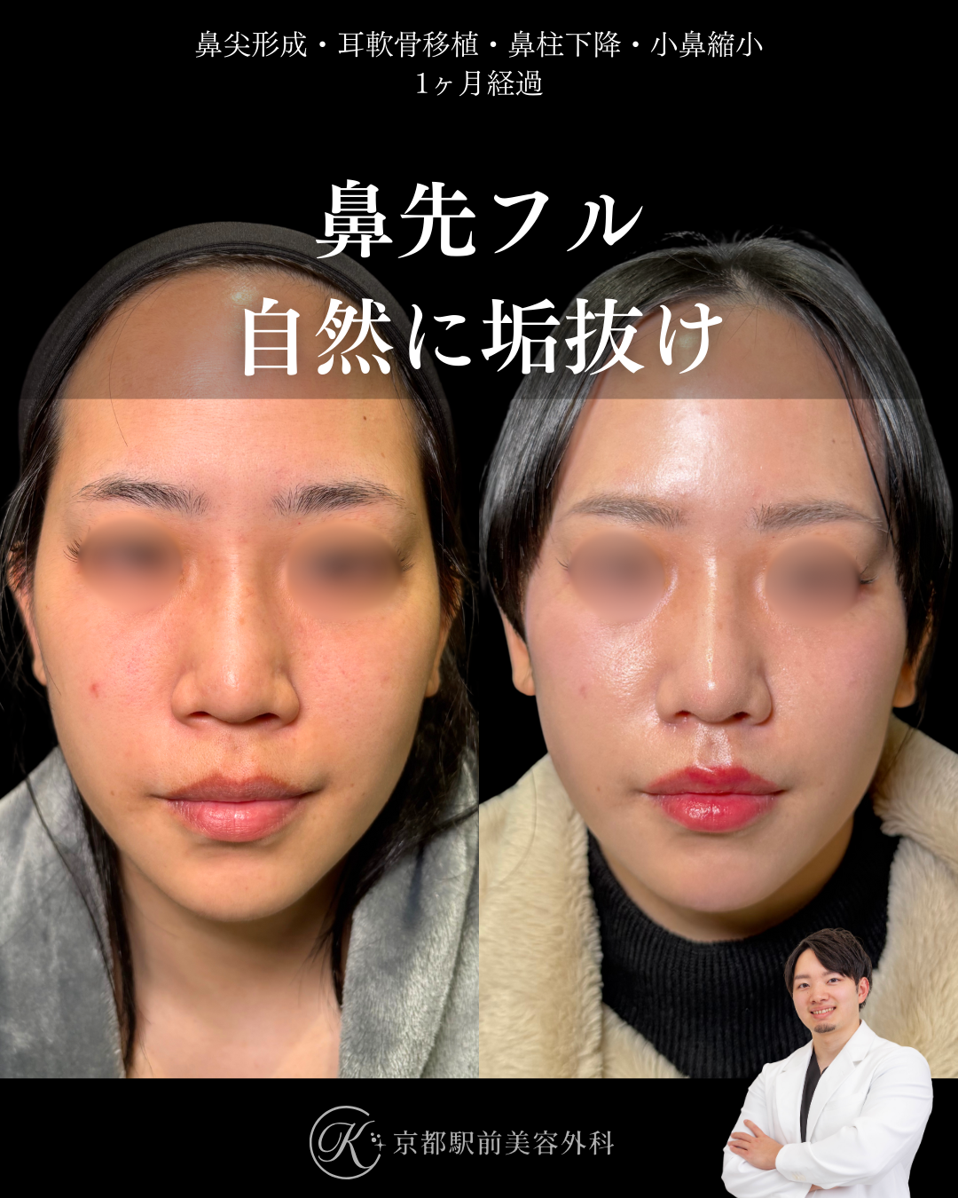 鼻先フル整形で自然に垢抜け。鼻尖形成・耳軟骨移植・鼻柱下降・小鼻縮小の1ヶ月経過写真(京都駅前美容外科の鼻整形症例)