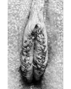 小陰唇縮小術 抜糸あり 手術直後