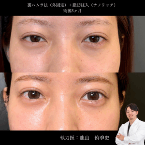 裏ハムラ法+脂肪注入術後1ヶ月