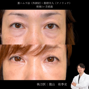 裏ハムラ法+脂肪注入術後1ヶ月