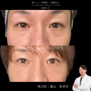 裏ハムラ法+脂肪注入術後1ヶ月